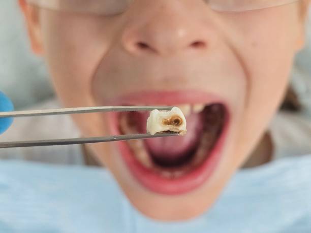 Best Emergency Treatment for Toothache in Strasburg, CO